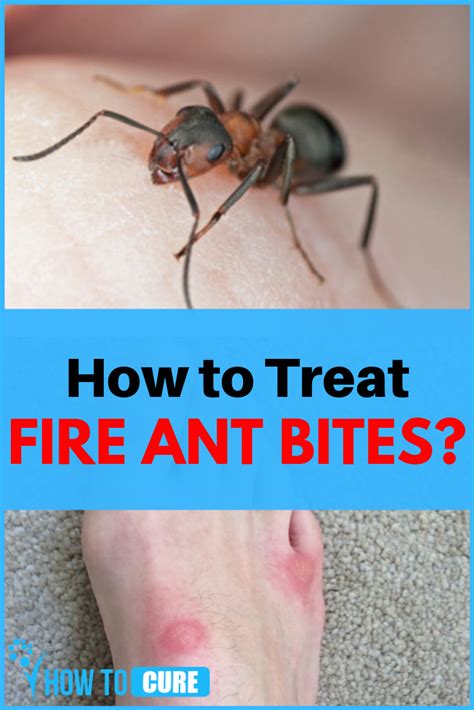 10 Home Remedies For Fire Ant Bites Howtocure Ant Bites Fire Ant