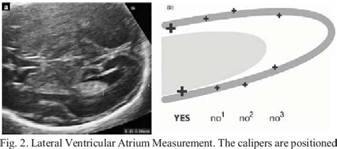 Figure 2 From Automated Cerebral Lateral Ventricle Ratio Measurement