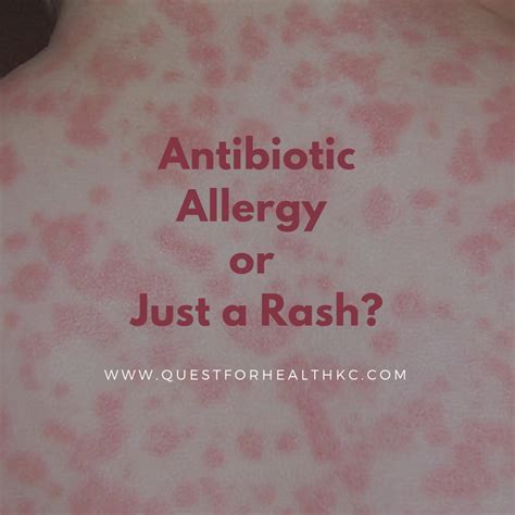Antibiotic Rash Treatment
