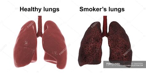 Smoker S Lungs Illustration And Light Micrograph Stock Image F