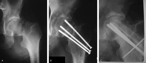 Salvage Of Failed Hip Fracture Fixation Journal Of Orthopaedic Trauma