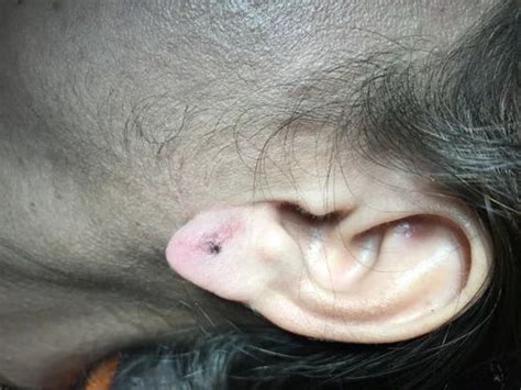 Ear Piercing After Split Ear Lobule Repair In Hanuman Nagar Nagpur