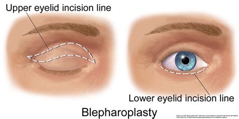 Eyelid Surgery Panama City Blepharoplasty Panama City The Eye