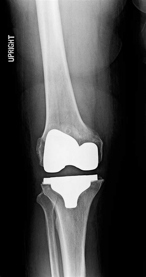 Orthodx Stiff Knee After Knee Replacement Clinical Advisor