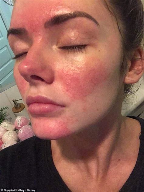 Pin On Severe Rosacea