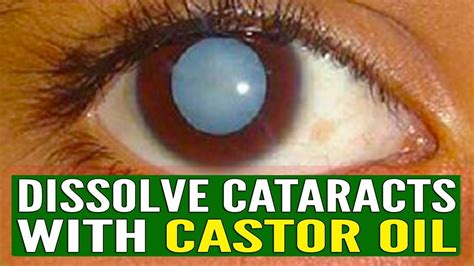 Changing lifestyle has made eye problems widespread. EYE CARE: How You Can Use Castor Oil To Dissolve Cataracts ...