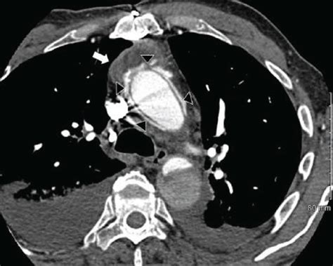 Ct Chest With Contrast White Arrows Show Periaortic Abscess In The