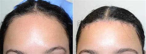 Hair Transplants For Women Photos Miami Fl Patient117260