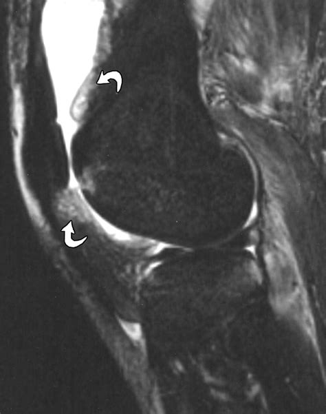 Mri Findings Of Septic Arthritis And Associated Osteomyelitis In Adults