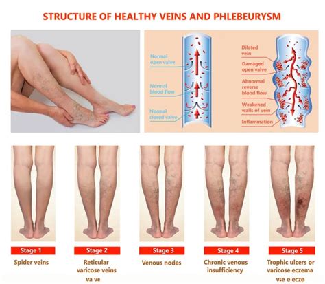Thrombophlebitis Deep Vein Thrombosis Varicose Veins Phlebeurysm Structure Of Normal Veins