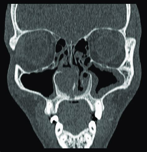 Preoperative Computed Tomography Scan Of The Paranasal Sinuses