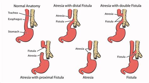 Image Result For Esophageal Atresia With A Tracheoesophageal Fistula