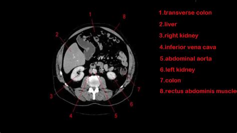 How To Read Ct Abdomen Axial Images Youtube