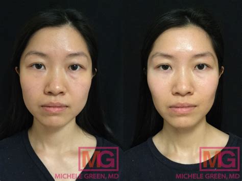 Non Surgical Jaw Reduction With Botox And Botox Masseter Muscles Nyc
