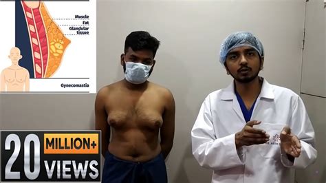 Grade 3 Gynecomastia Its Diagnosis And Treatment Learn Everything