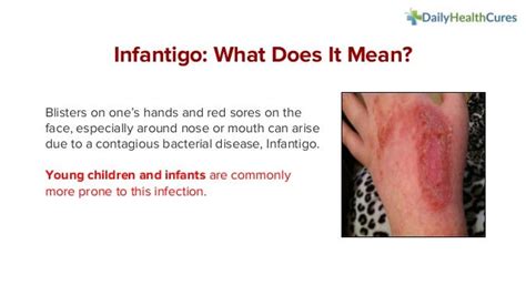 Infantigo Types Causes Contagious Symptoms And Treatments
