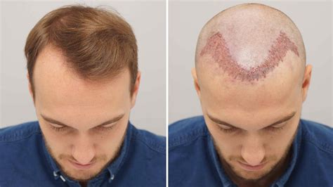 Best Hair Loss Treatment For Men To Uncovered Of Maturing Procedure