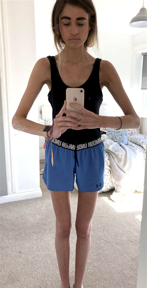 Anorexic Woman Beats Eating Disorder After Doctors Warn Her Organs Can Fail On Flight