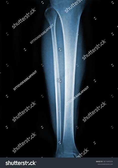 Xray Normal Human Tibia Lateral View Stock Photo 1811645929 Shutterstock
