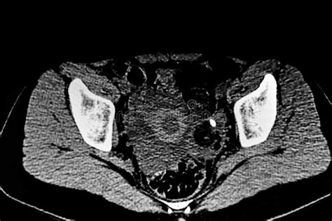 Abdominal Ct Scan Of The Abdomen Showing A Teratoma Tumor In The Left