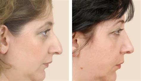 Nose Job Surgery Procedure