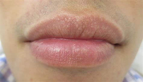 Fordyce Spots On Lips And Shaft Causes And Treatment