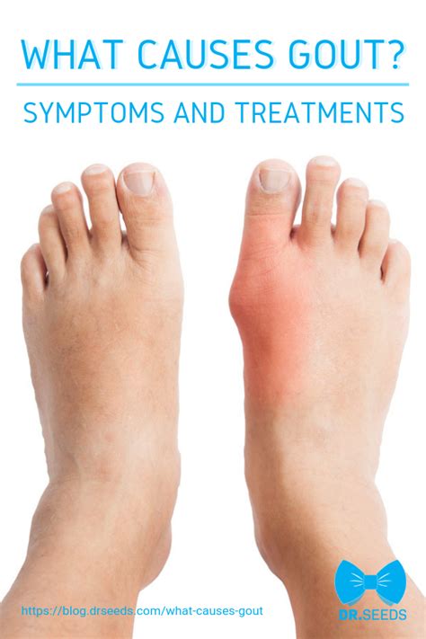 What Causes Gout With Images Gout Symptoms Gout Remedies