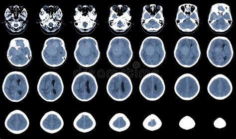 Ct Brain Axial Scans Hyperdense Mass With Homogeneous And Mild