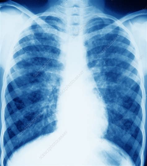 Cystic fibrosis is an inherited condition in which the lungs and digestive system can become clogged with thick, sticky mucus. Cystic fibrosis, X-ray - Stock Image - M130/0745 - Science ...