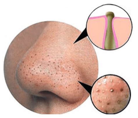 Eliminate Blackheads Using This Really Easy And Effective Trick Try This Now Virality Facts
