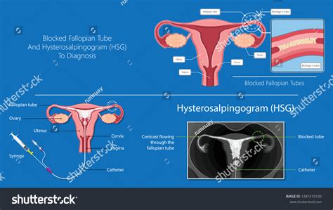 Hysterosalpingogram Hsg Test Blocked Fallopian Tubes