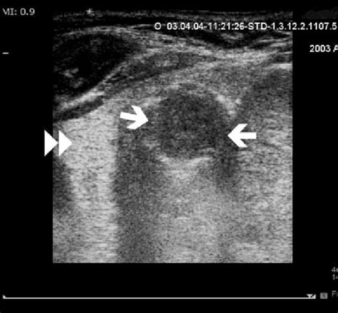 Sonographic Image Shows A Well Delineated Hypoechoic Mass Arrows At