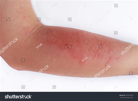 Allergic Rash Dermatitis Eczema Skin Patient Stock Photo 535019623