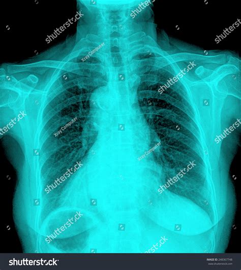 Chest Xray Scan Medical Diagnosis Stock Photo 248367748 Shutterstock