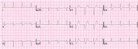 First identified in 2008 by dr. Dr. Smith's ECG Blog: Is the LAD really completely ...