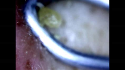 Usb Microscope From Ebay Test Blackheads And Whiteheads Youtube