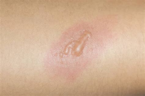 Burn Blister Stock Photos Pictures And Royalty Free Images Istock