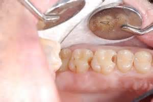 A simple filling may take as little as 20 minutes. Tooth Filling Cost | Auckland NZ | Dental Fillings in Epsom
