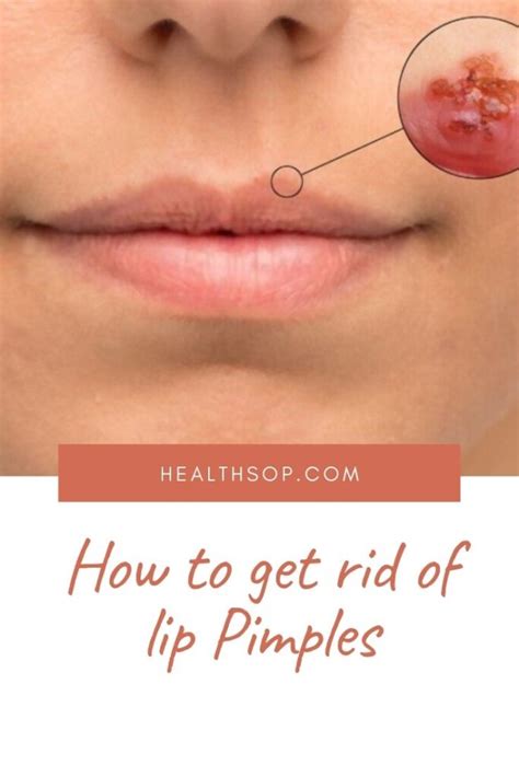 How To Get Rid Of Lip Pimples