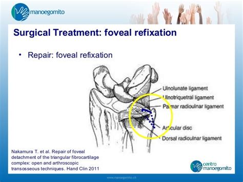 Acute Triangular Fibrocartilage Complex Injuries Treatment And Managem