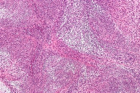 Malignant Peripheral Nerve Sheath Tumor Pathophysiology Wikidoc