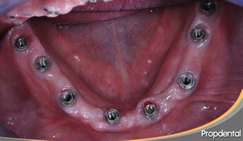 El titanio de los implantes dentales Biomateriales en implantología