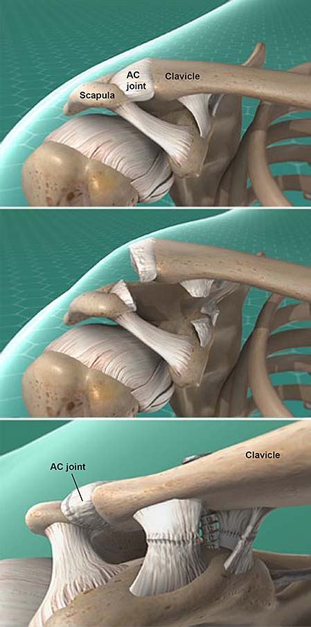 Acromioclavicular Ac Joint Separation Repair Central Coast