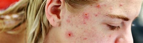 Can Food Allergies Cause Back Acne