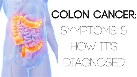 Colon Cancer Symptoms And How It S Diagnosed YouTube