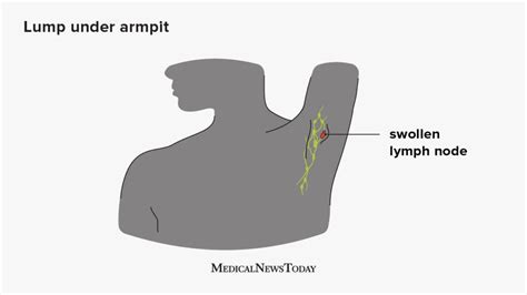 Bacterial Infection Armpit Lump