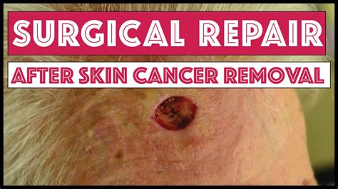 Dermatology Surgical Repair After Removal Of Skin Cancer On Forehead