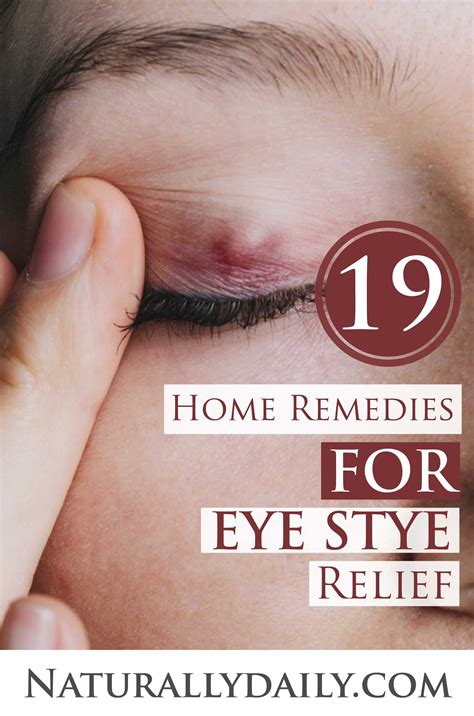 19 Home Remedies For Eye Stye Relief In 2020 With Images Sty In Eye