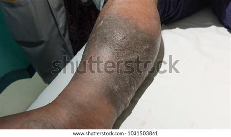 Hyperpigmentation Skin Cellulitis Lower Limb Patient Stock Photo Edit