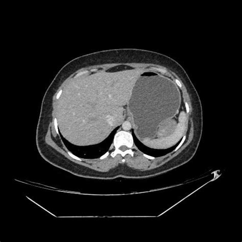 Axial Ct In The Arterial Phase Shows A Similar Lesion In The Left